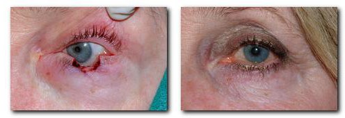 eyelid reconstruction surgery
